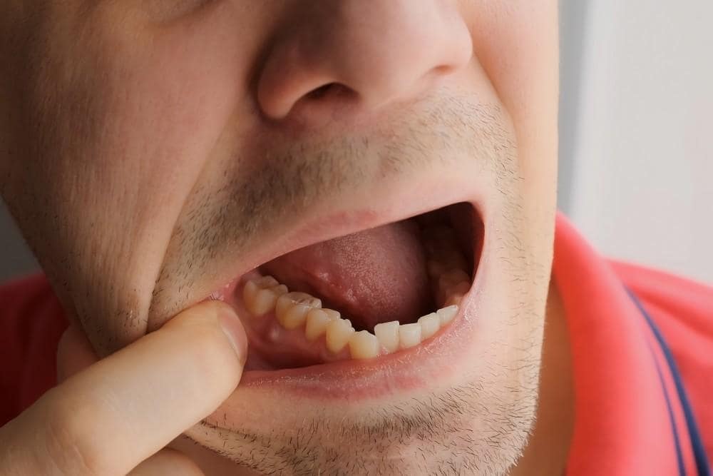 How to Prevent Tooth Infections