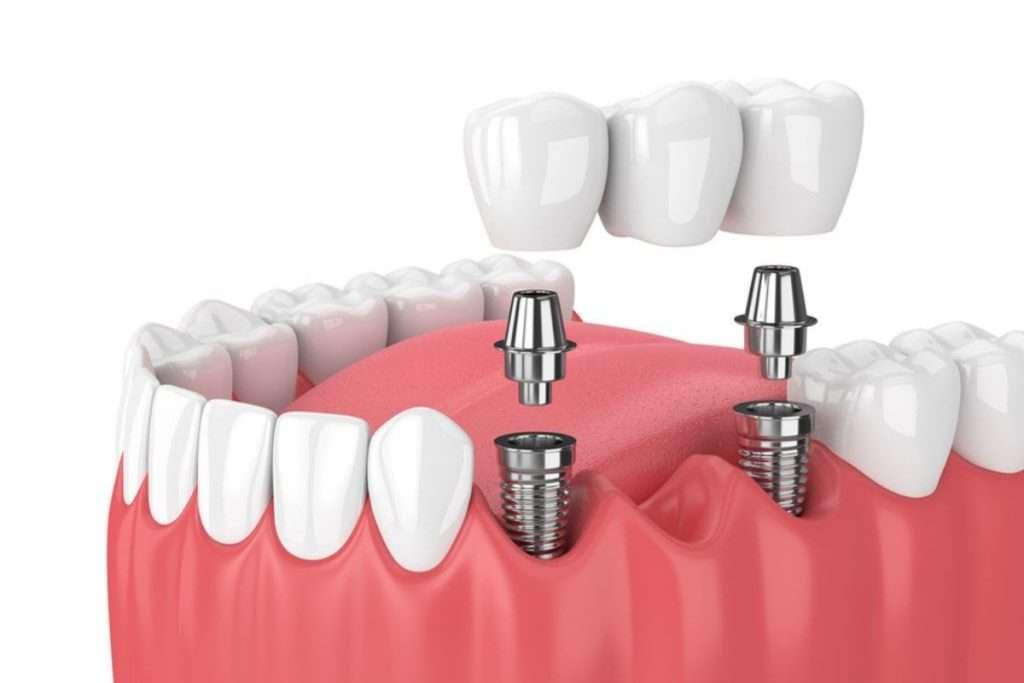 Dental Implants Cost in Fall River