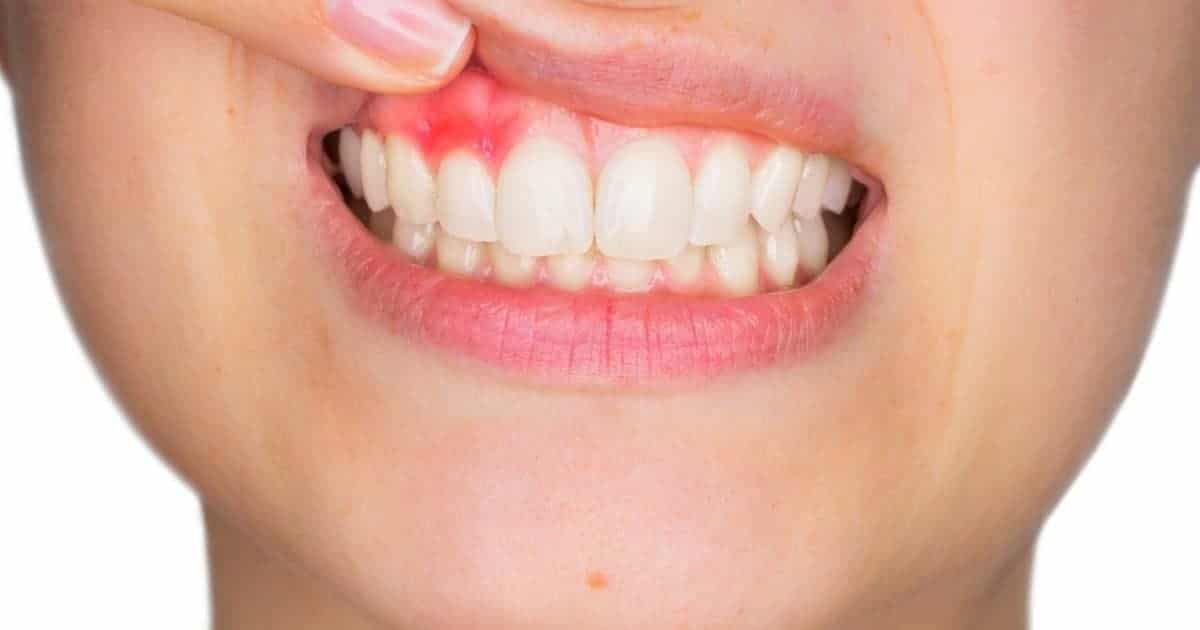 Why Tooth Infections Spread So Easily