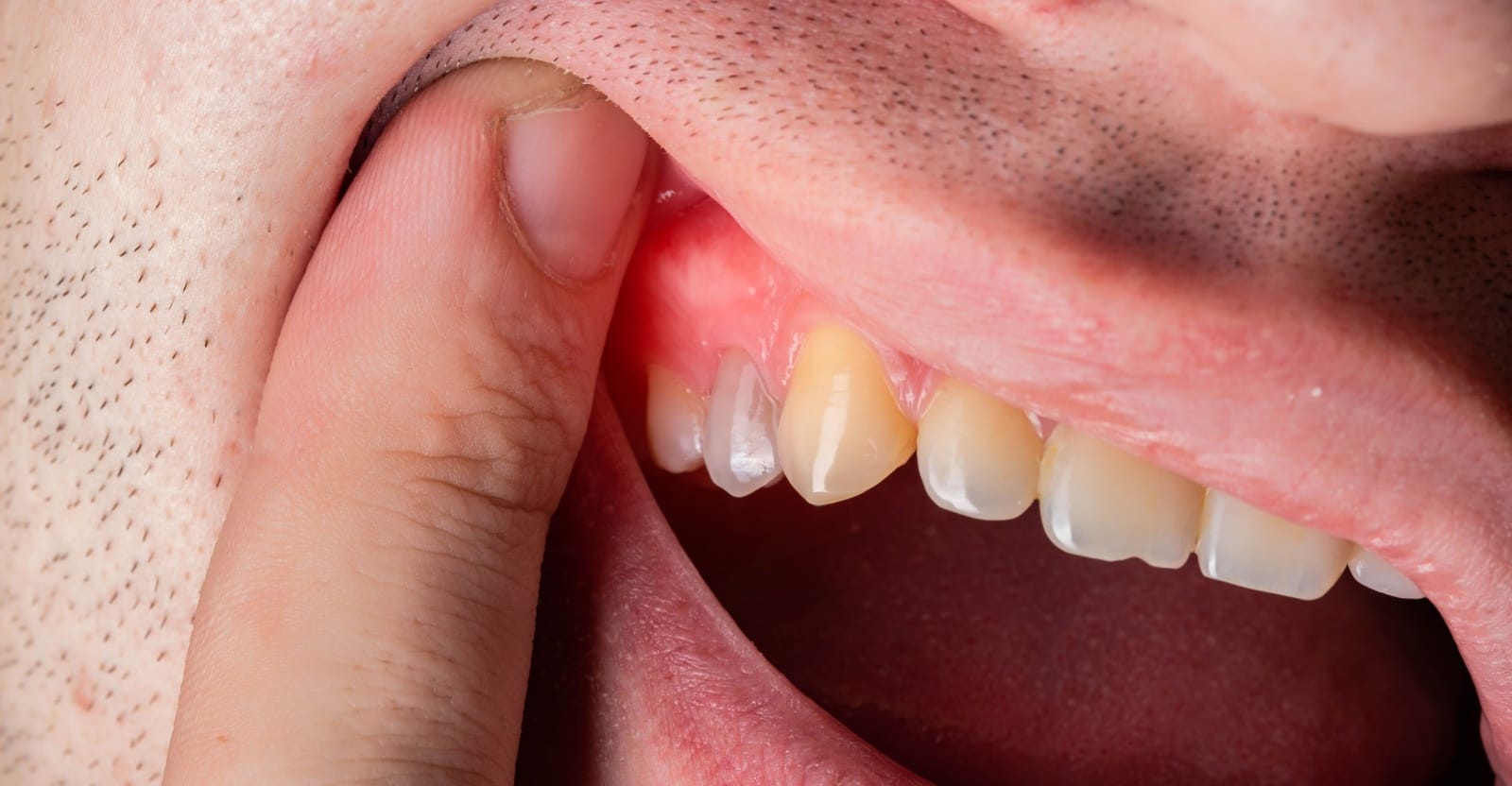 Infection Inside the Tooth