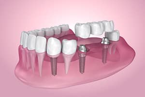 dental crowns