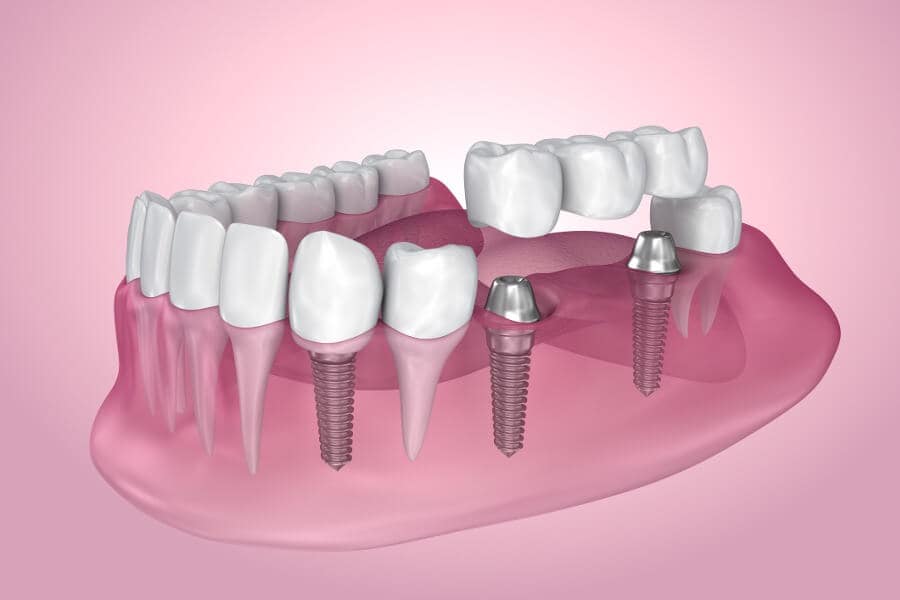 dental crowns